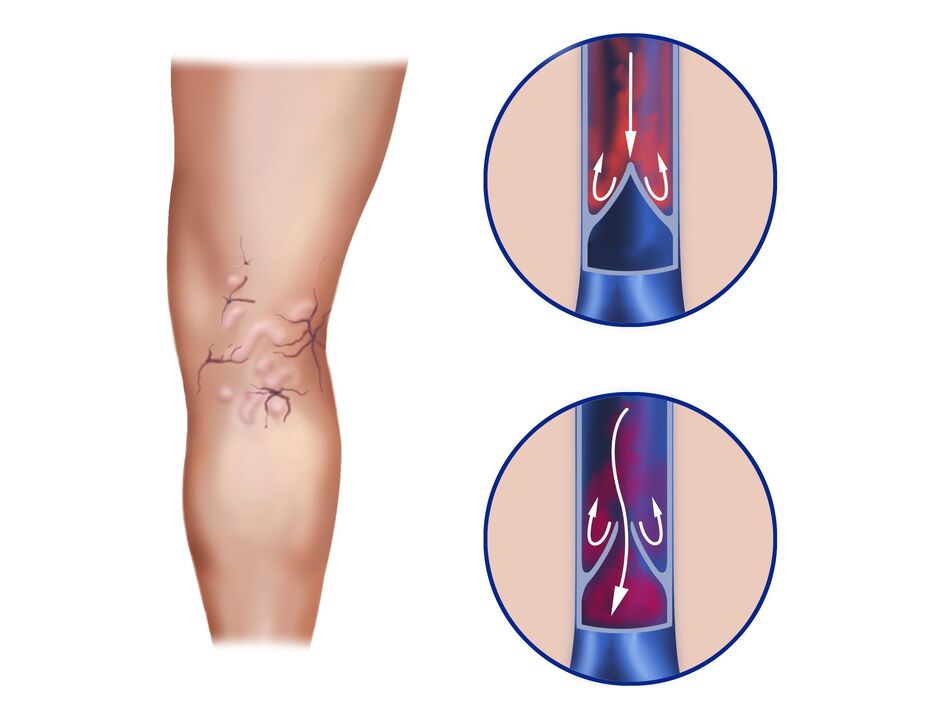 veins varicose